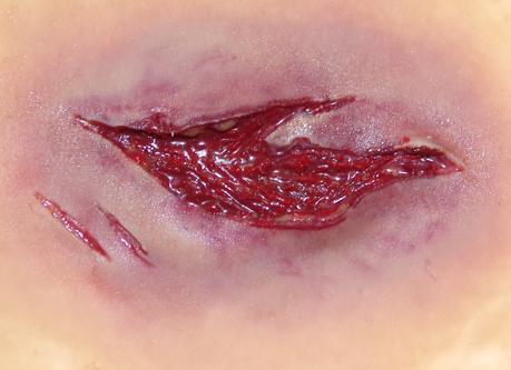 Self Adhesive Wounds Laceration Medium Tactical Distributors Ltd New Zealand