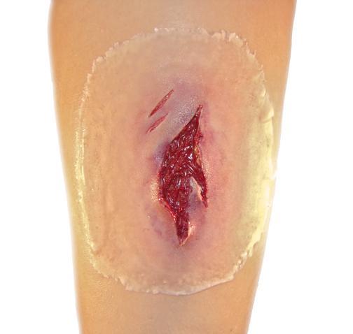 Self Adhesive Wounds Laceration Medium Tactical Distributors Ltd New Zealand